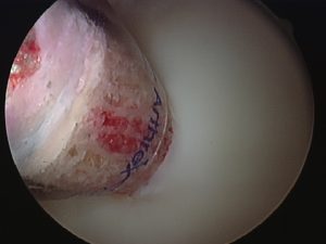Inserting a cylinder of bone and cartilage taken from another part of the knee for a cartilage injury