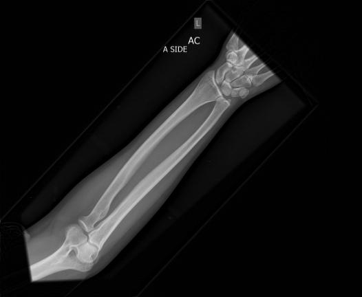 Albert Pujols breaks bone in forearm | Dr. David Geier - Sports