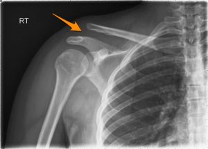 X-ray of a separated shoulder