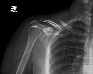 Clavicle fracture: Mechanism of injury, diagnosis and treatment | Dr