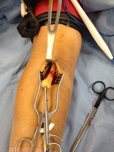 Treatment of a biceps tendon rupture often involves surgery to reattach the torn biceps tendon.