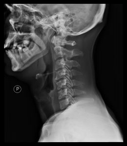 Cervical spine injuries can occur in collision sports like football.