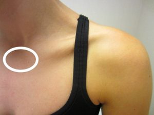 Treatment of a sternoclavicular dislocation depends on the direction of injury.