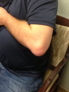 Patient with olecranon bursitis of his elbow