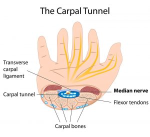 Illustration of carpal tunnel syndrome