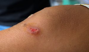 An open wound could become an MRSA infection