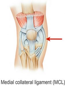 Illustration of the MCL of the knee