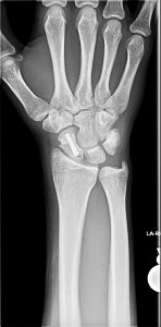 Xray showing a scaphoid fracture fixed surgically with a screw