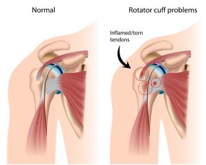 Illustration of the rotator cuff tendons