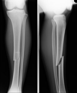 What factors could increase the risk of delayed healing of this tibia fracture?