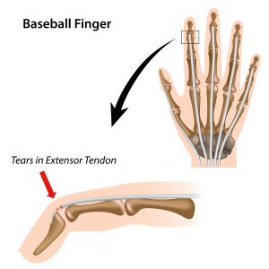Illustration of a mallet finger injury