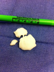 Fragments removed during surgery for an OCD lesion of the knee