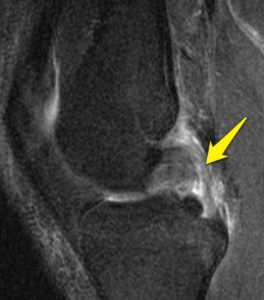 An MRI showing a PCL injury of the knee