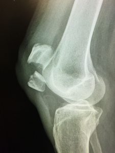 X-ray showing a displaced patella fracture