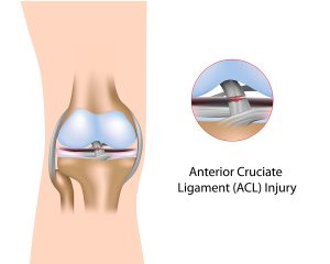 Why it's hard to play soccer with a torn ACL