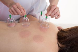 Are cupping and other recovery treatments helpful?