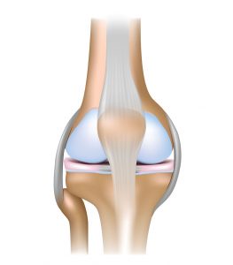 A quadriceps tendon rupture involves the tendon just above the patellar (kneecap).