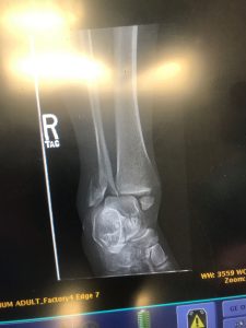 X-ray of an ankle fracture treated surgically