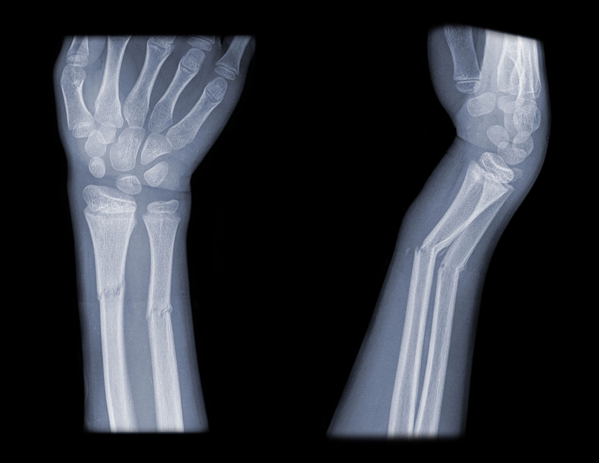 How to know if you broke a bone Dr. David Geier Sports