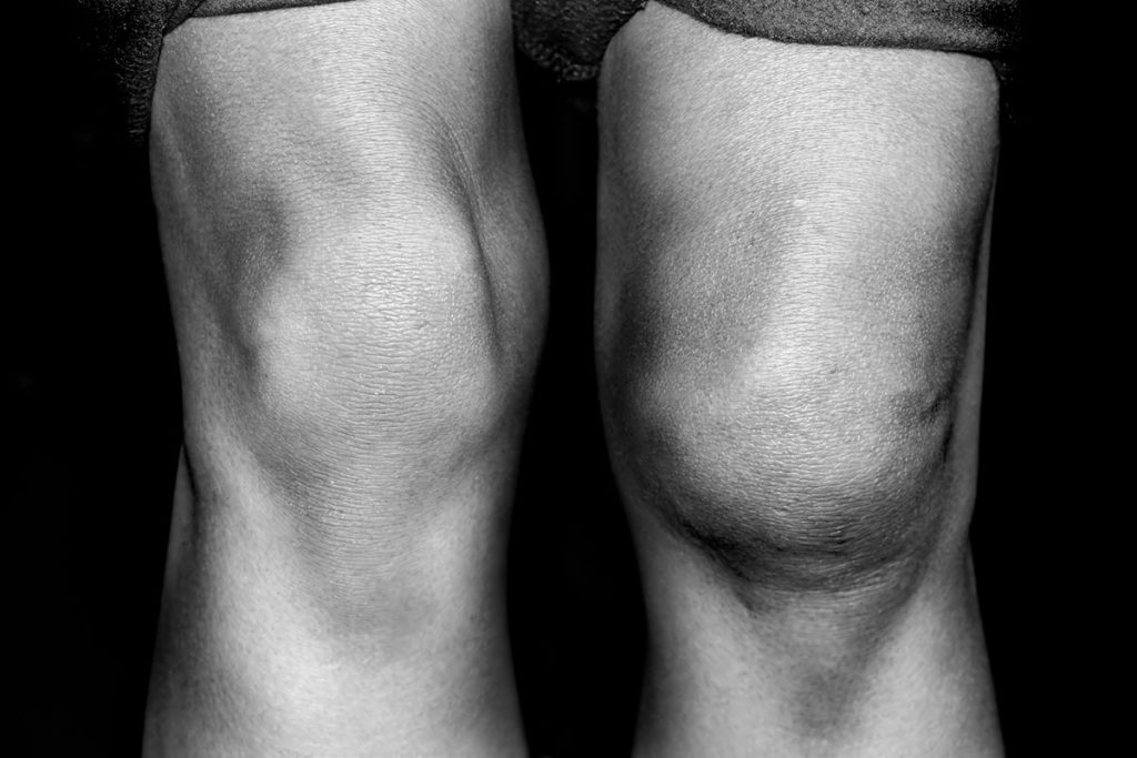 Is it normal to have swelling after knee surgery? | Dr. David Geier