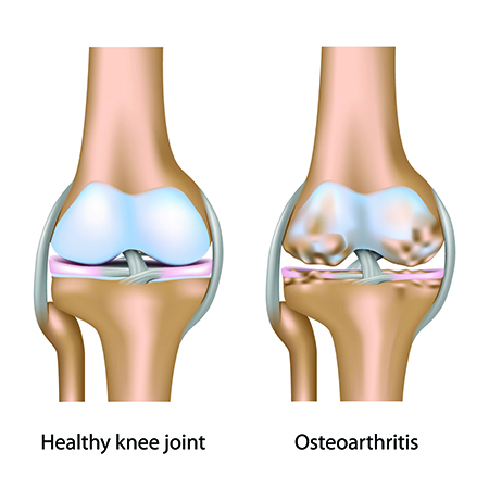 Illustration of the damaged bone and cartilage in osteoarthritis
