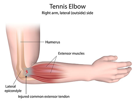 Illustration of tennis elbow injury