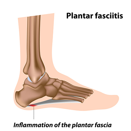 Illustration of plantar fasciitis