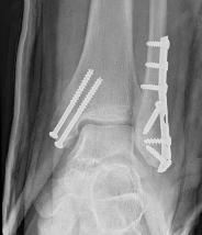X-ray of ankle after surgery to fix the fracture with a plate and screws