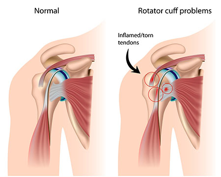 Illustration of rotator cuff injuries